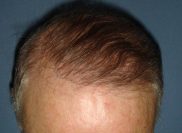 Crown Clinic Hair Transplant Manchester