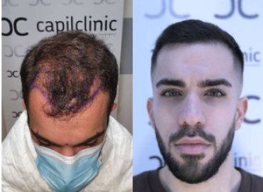 Capilclinic Hair Transplant in London