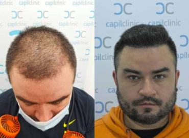 Capilclinic Hair Transplant in London