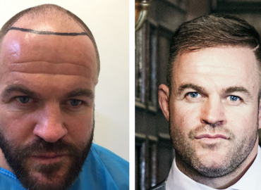 Head Quarters Cardiff Hair Transplant
