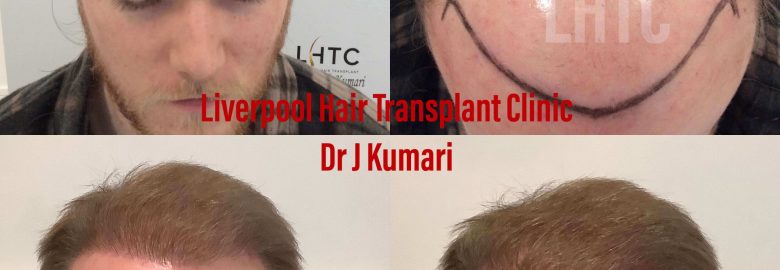 Liverpool Hair Transplant Clinic