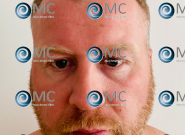 Manchester Clinic FUE Hair Transplant