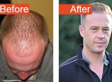 Hair Transplant Clinic Manchester