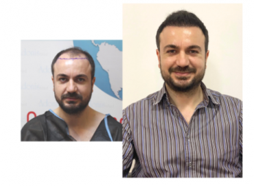 ADONIS Hair Transplant Istanbul