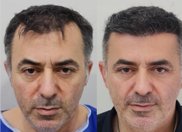 AVRUPA Hair Transplant Istanbul