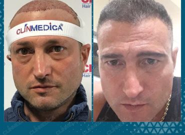 ClinMedica Turkey Hair Transplant & Plastic Surgery Istanbul