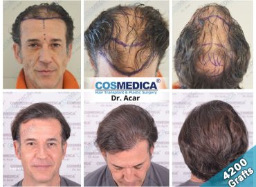 Hair Transplant Clinic Başlık Sk Istanbul