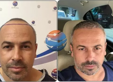 Drpilus Hair Transplant & Aesthetics Hair Clinic Istanbul