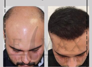 Emax Hair Transplant Istanbul