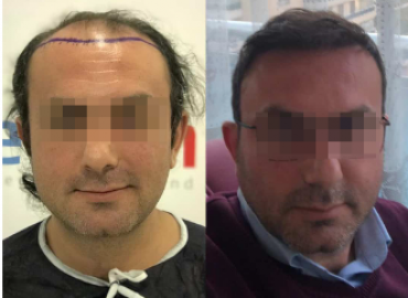 Estenbul Medical Travel And Assistance Hair Transplant Istanbul