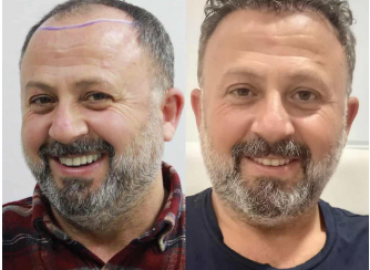 Estenbul Medical Travel And Assistance Hair Transplant Istanbul