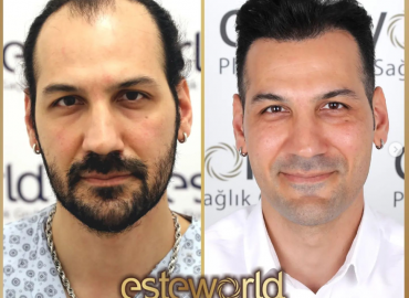 Esteworld Istanbul Hair Transplant in Turkey