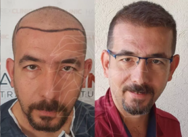 HAAREX Clinic Hair Transplant Istanbul