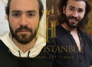 Hair of Istanbul FUE Hair Transplant in Turkey