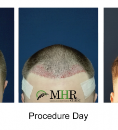 Medical Hair Restoration Clinic Hair Transplant in Dublin