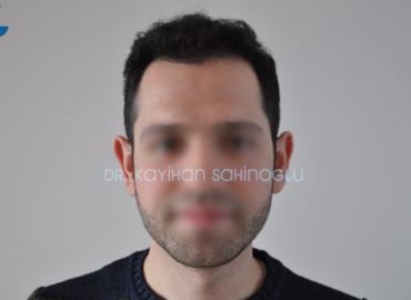 Prof Dr Kayihan Sahinoglu Hair Transplant Istanbul