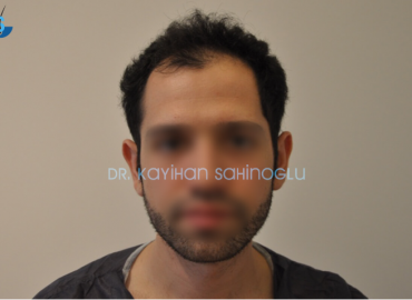 Prof Dr Kayihan Sahinoglu Hair Transplant Istanbul