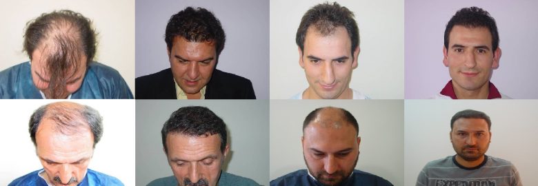 Troy Hair Clinic Istanbul