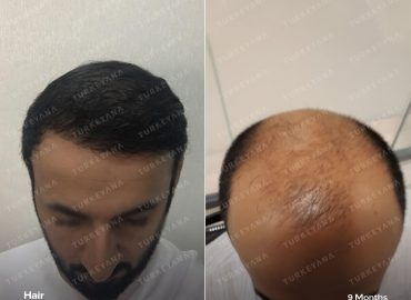 TURKEYANA Turkey Hair Transplant