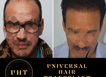 Universal FUE Hair Transplant Turkey Istanbul