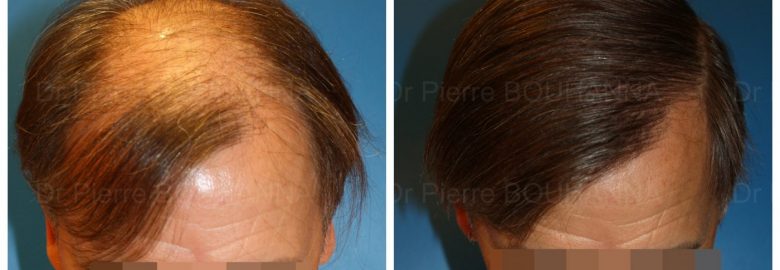 Dr Pierre Bouhanna Chirurgie Capillaire Exclusive Paris Greffe de Cheveux FUE
