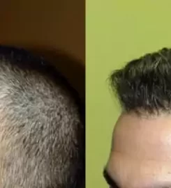 Dr Turowski Hair Restoration Clinic Przeszczep Włosów Metoda FUE