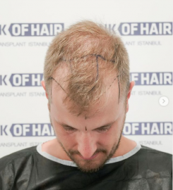 Bank of Hair Hannover die FUE Haartransplantation