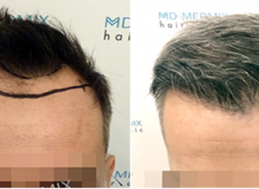 MD Medmix Hair Clinic. Polska, przeszczep włosów metodą FUE