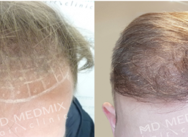 MD Medmix Hair Clinic. Polska, przeszczep włosów metodą FUE