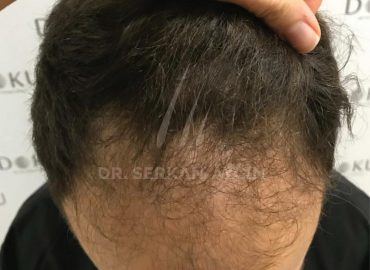 Dr Serkan Aygin Haartransplantation